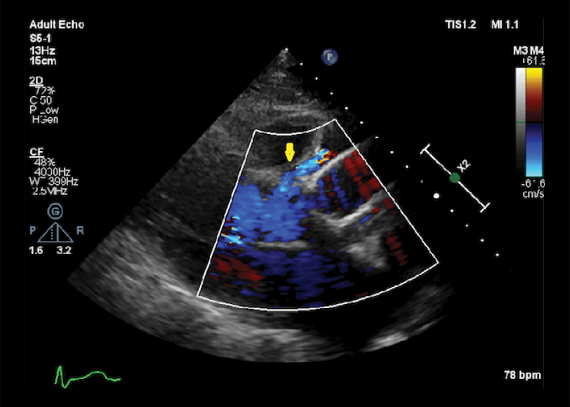 Late Dehiscence of Mechanical Aortic Valved Conduit and Distal Anastomotic Leakage due to Endocarditis Caused by Pseudomonas stutzeri